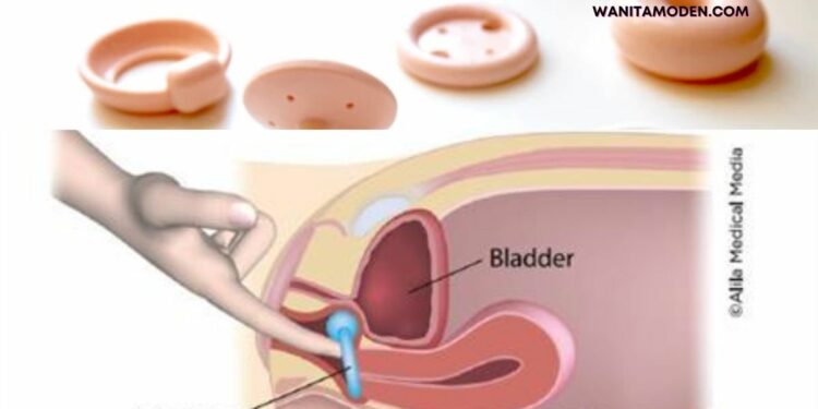 cara-mengatasi-kentut-faraj