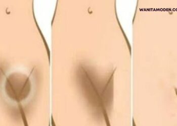 cara memutihkan miss v