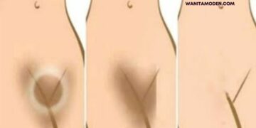 cara memutihkan miss v