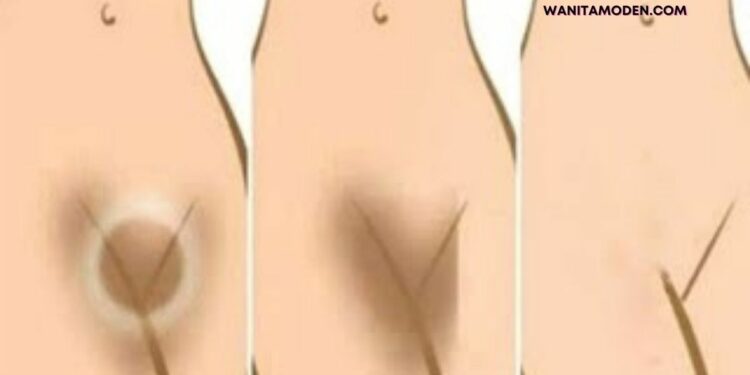 cara memutihkan miss v