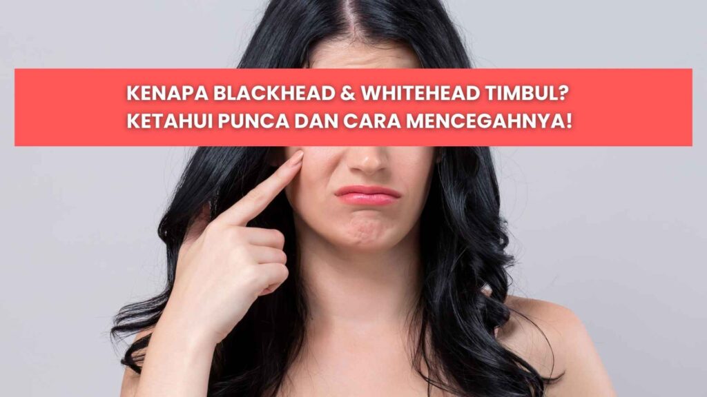 punca blackhead dan whitehead