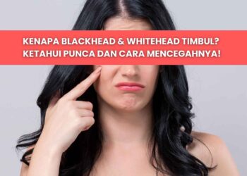 punca blackhead dan whitehead