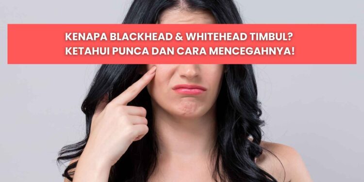punca blackhead dan whitehead